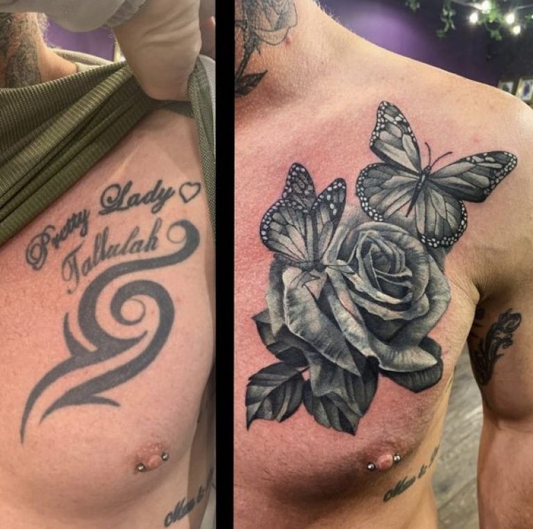 New Laser Tattoo Removal