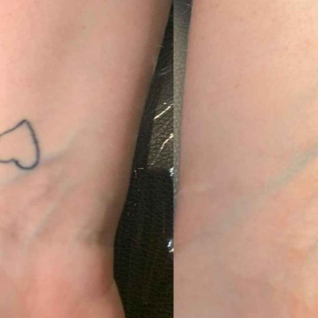 Birmingham's Tattoo Removal Experts | Get Your Free Consultation Today