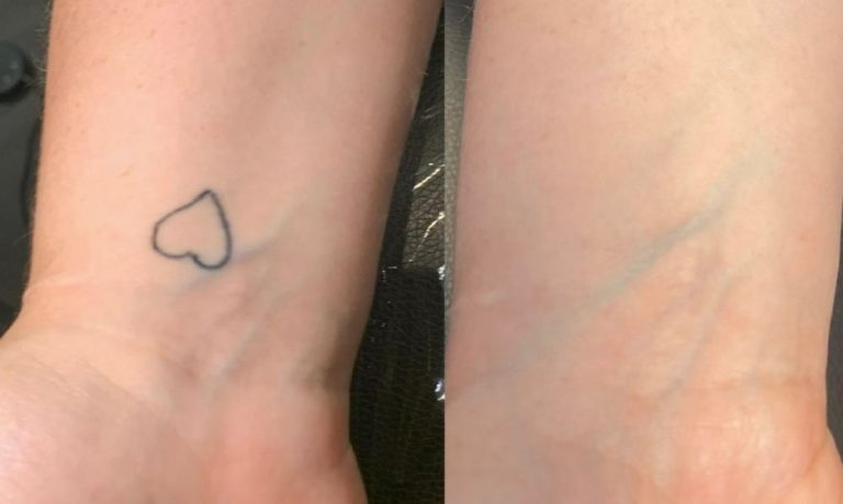 Before Laser - A History Of Tattoo Removal